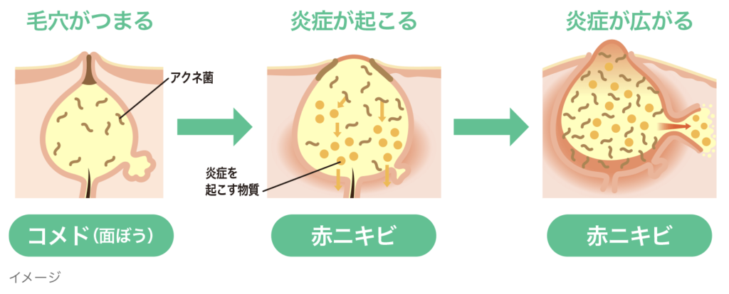 拭き取り化粧水オードムーゲで大人ニキビを防ごう｜ニキビが出来る原因と対策